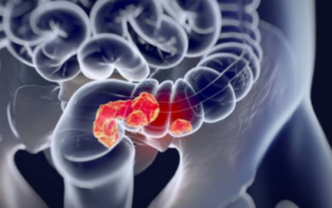 Gastrointestinal-Cancer