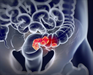 Gastrointestinal Cancer