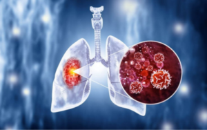 Lung-cancer