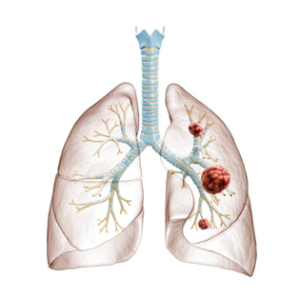 Lung cancer