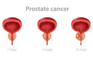 Prostate_cancer