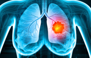 Lung Cancer Treatment in Mumbai