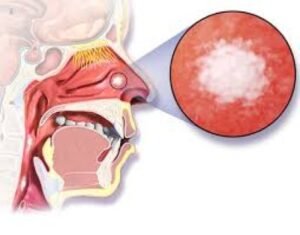 Sinus and Nasal Cavity Cancer