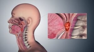 Throat Cancer (Pharyngeal Cancer)