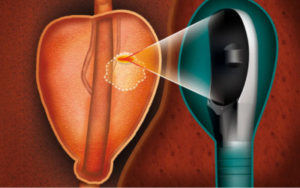 Focal-Therapy