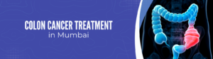 colon-cancer-Treatment