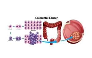 Colorectal-Cancer