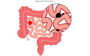 Small-Intestine Cancer