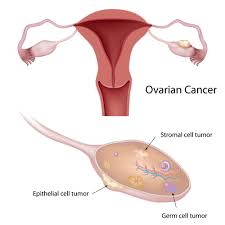 What is Ovarian Cancer?